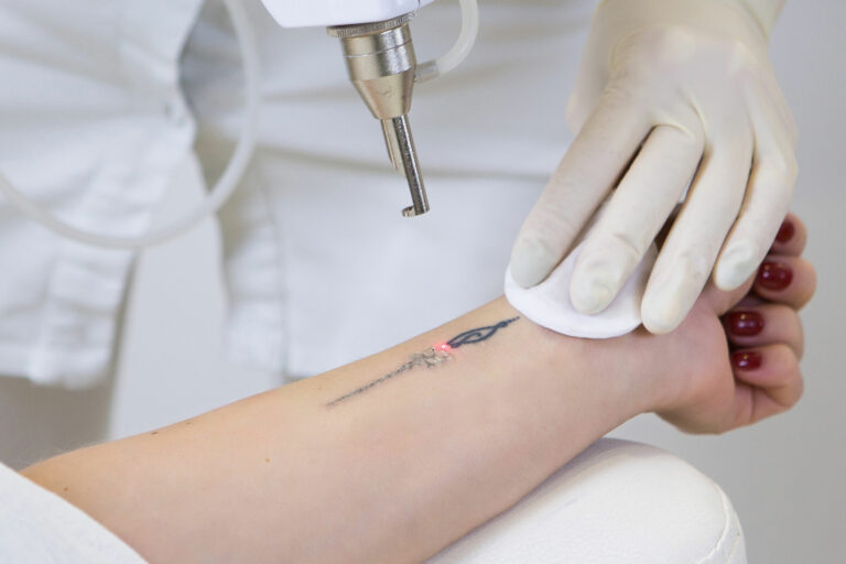 Inside Laser Tattoo Removal